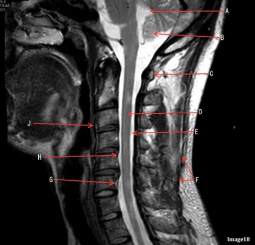 <p>Letter H in Image 18 is pointing to:</p><p>A. Anterior longitudinal ligament (ALL)</p><p>B. Posterior longitudinal ligament (PLL)</p><p>C. Spinous ligament</p><p>D. Venous plexus</p>