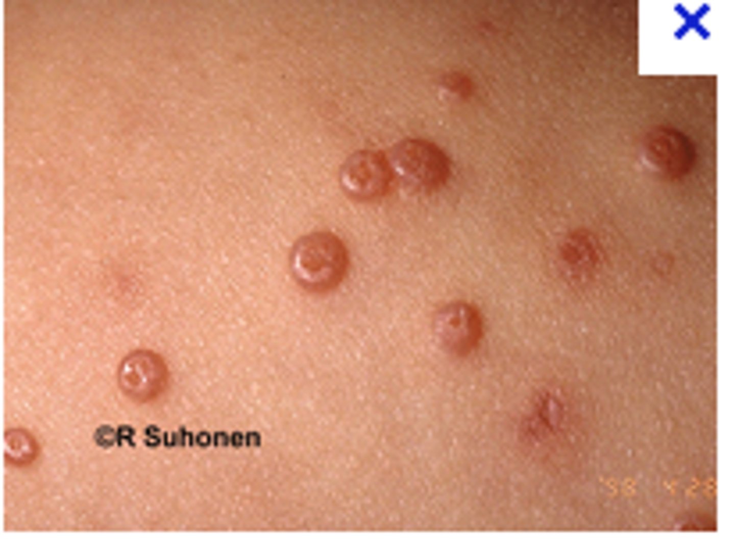 <p>skin nodule with central depression</p>