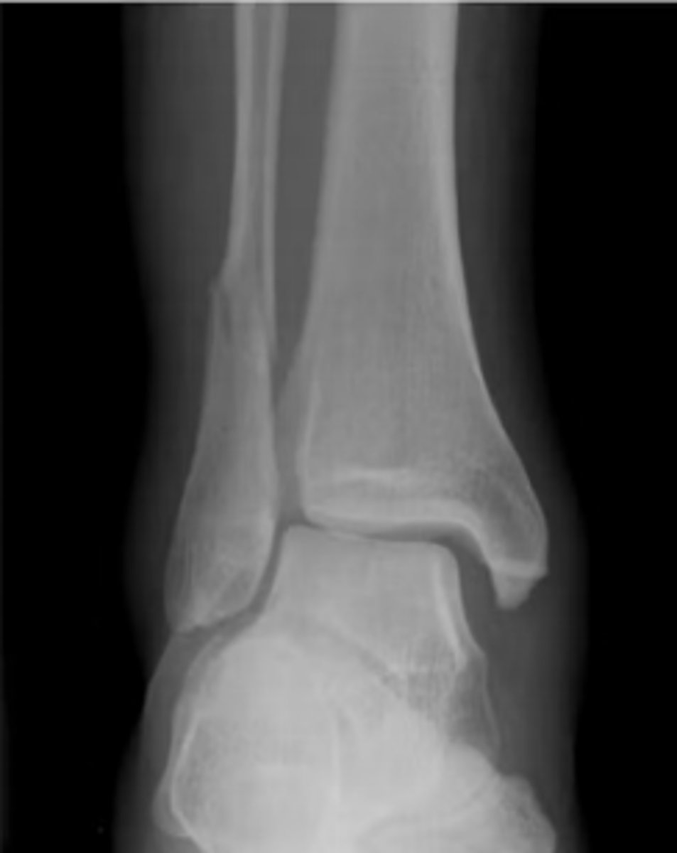 <p>According to the Danis-Webber classification - what type of ankle fracture does this x-ray show?</p>