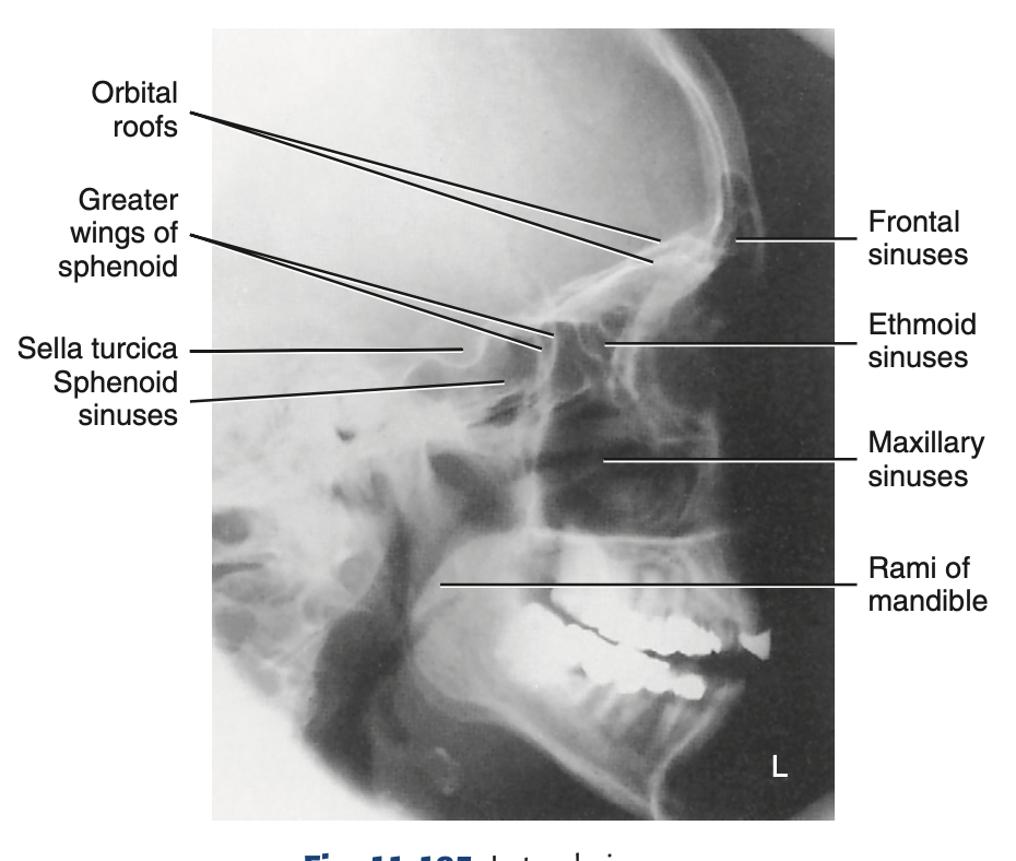 <p>How do you <u>critique</u> radiograph of <strong>RT and LT lateral </strong>for <strong>sinuses?</strong></p>