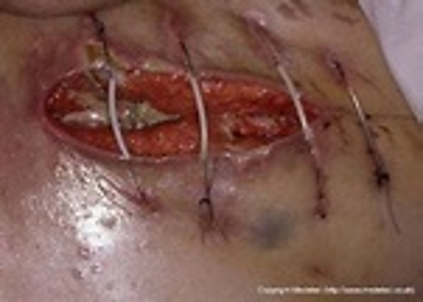 <p>opening of a wound's suture line</p>