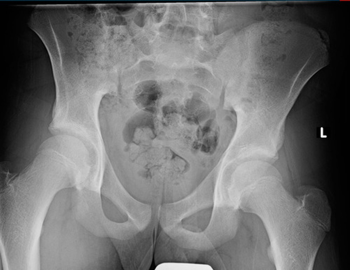 <p>What grade Risser sign is this?</p>