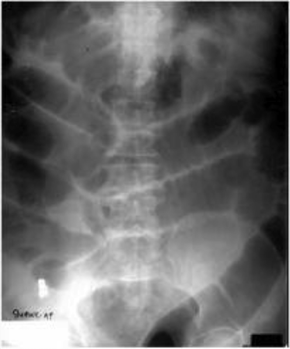 <p>acute paralytic ileus → XR shows diffuse gas filled loops of small and large bowel</p>
