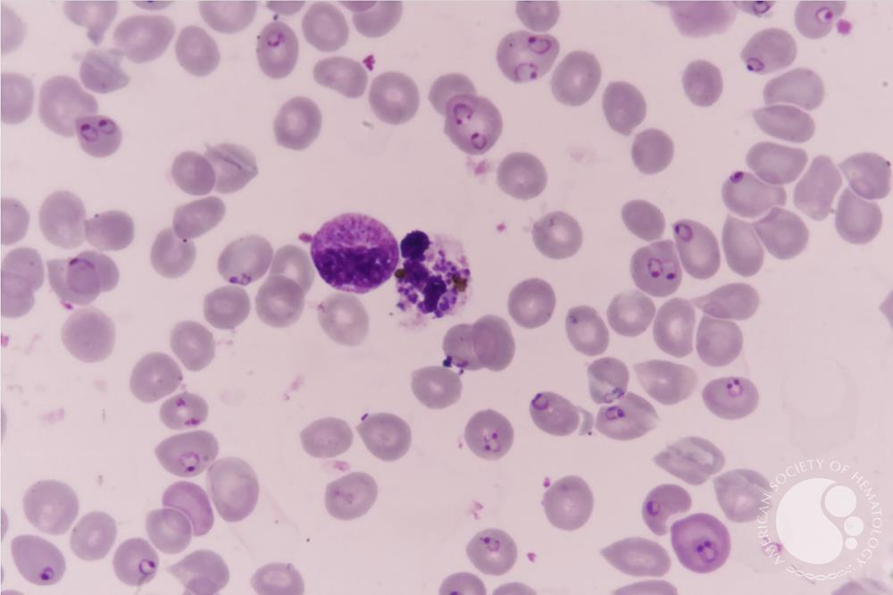 <p>Apicomplexa </p><p>causes malaria</p>