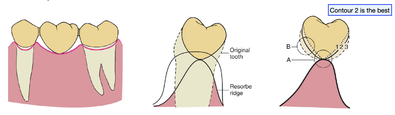 <p>mandibular posterior teeth: esthetic is a lesser concern </p>