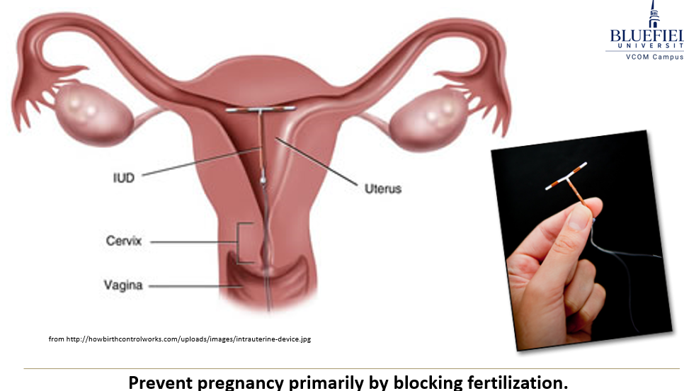 <p> <strong>IUDs</strong> come in types like <strong>inert, copper, hormonal</strong>, or <strong>combination</strong>. They can <strong>shorten sperm lifespan</strong>, <strong>decrease sperm motility</strong>, and some forms may help <strong>prevent implantation</strong>.</p>