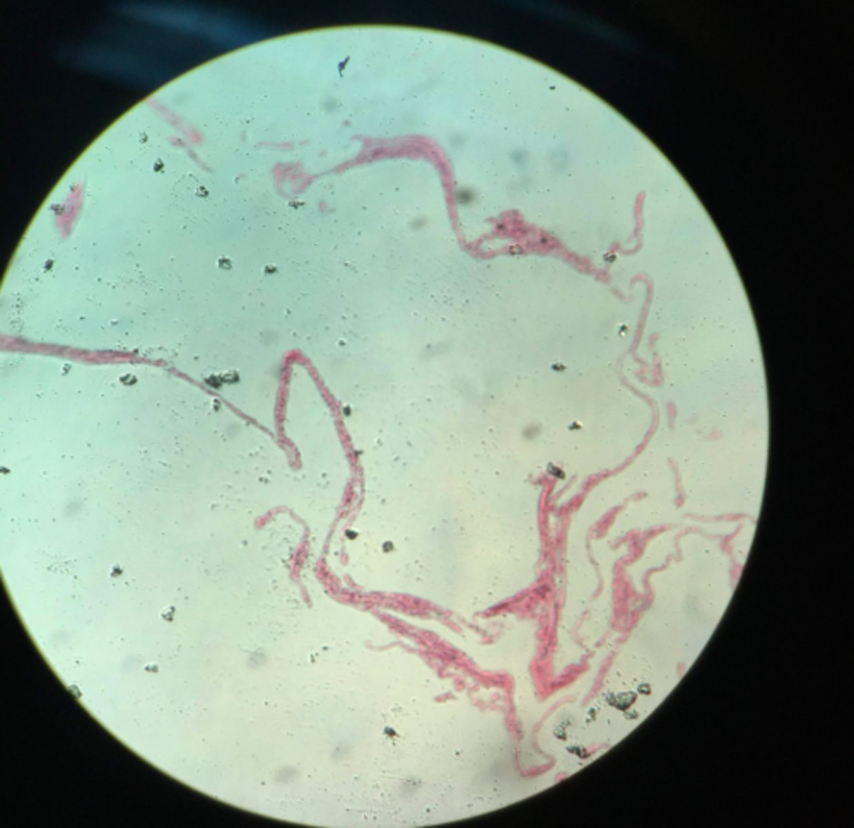 <p>What type of tissue depicted on this slide? What condition did this person have?</p>