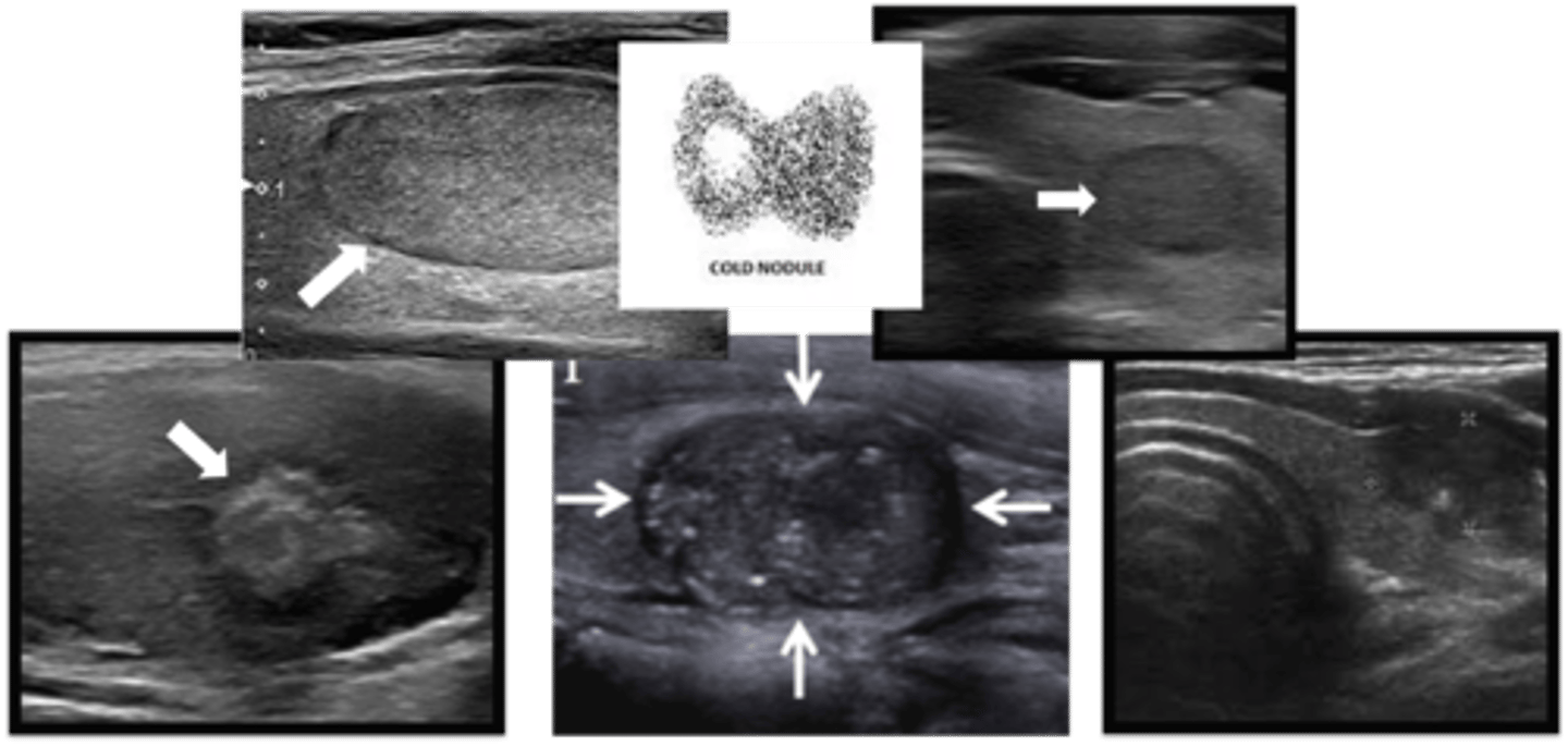 <p>Define Condition:</p><p>Abnormal growth of thyroid cells --&gt; lump in thyroid gland</p><p>-Hx: Only 5%</p><p>&gt; Age &lt; 30 yrs</p><p>&gt; Hx of Radiation to head/neck</p><p>&gt; FHx of Thyroid Cancer</p><p>-Types:</p><p>&gt; Papillary Carcinoma</p><p>&gt; Follicular Carcinoma</p><p>&gt; Medullary Carcinoma</p><p>&gt; Anaplastic Carcinoma</p><p>-PE:</p><p>&gt; Asymm enlargement of Thyroid Gland</p><p>&gt; Fixed and/or Firm</p><p>-Dx: </p><p>Labs</p><p>&gt; TSH = LOW</p><p>Imaging</p><p>&gt; Incidental Finding</p><p>&gt; Radioiodine = COLD (low)</p><p>&gt; Thyroid US = Nothing or Worrisome --&gt; Fine Needle Aspiration = WORRISOME (SOLID, HYPOECHOIC, IRREGULAR MARGINS, EXTRATHYROIDAL EXTENSION, CALCLIFICATIONS)</p><p>-Tx: REMOVAL</p>