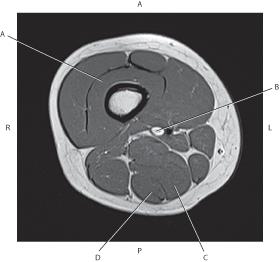 <p><span style="color: yellow">Which line is pointing to the vastus intermedius muscle?</span></p>