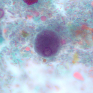 <p>distorted and irregularly shaped nucleus </p>