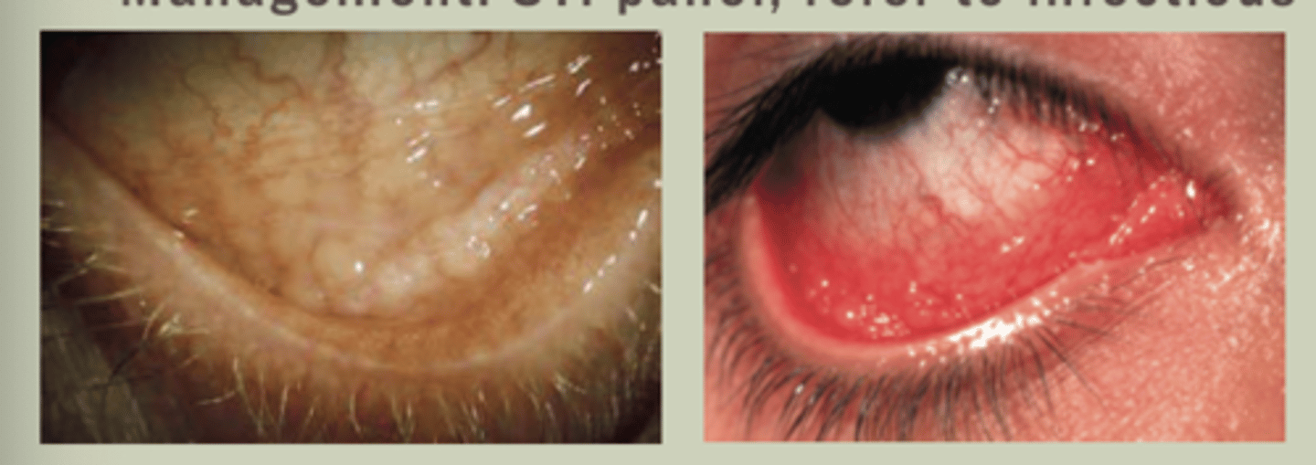 <p>-Unilateral, chronic red with marked inferior follicles</p><p>-Trachoma Serotypes A-C; Adult inclusion is D-K</p><p>-Usually dx of exclusion</p><p>-TX: 1g azithromycin PO</p><p>-Management: STI panel, refer to ID</p>
