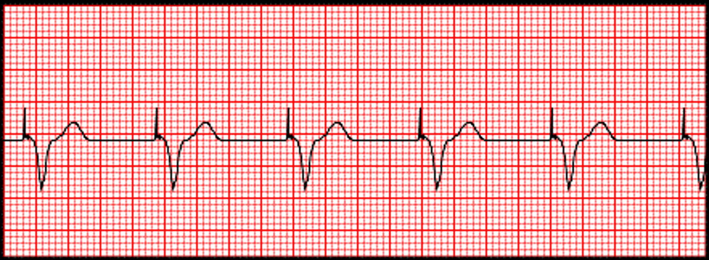 <p>spike before QRS</p>