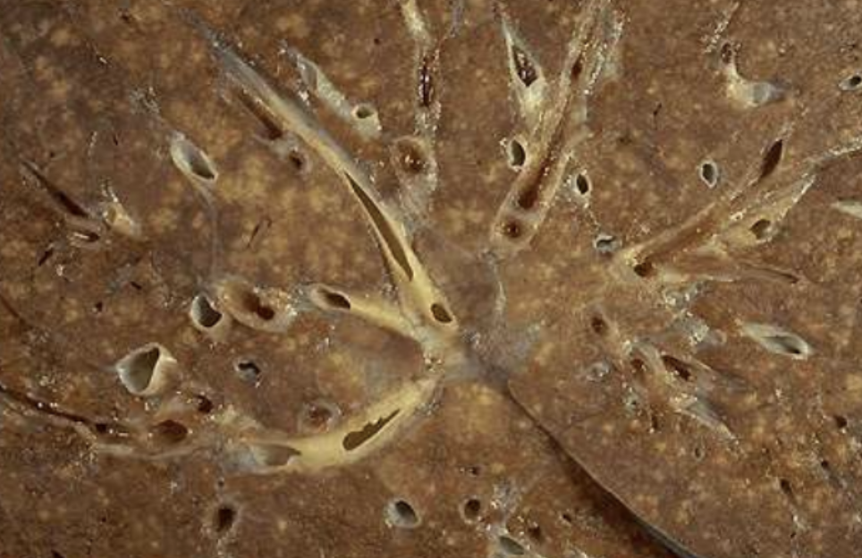 <p>A chronic form with granulomas; often cell-mediated; TB and certain fungi are examples.</p>