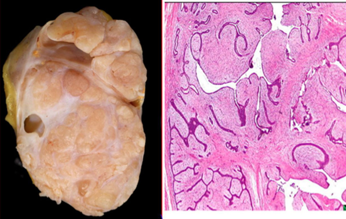 <p>Define Condition:</p><p>Stromal fibroepithelial tumor (tumor of fibrous tissue and glands but the stromal cells outgrow the epithelial component)</p><p>-Hx; Post-Menopausal women</p><p>-Path: FAST GROWING tumor; Generally BENIGN, but has potential to be malignant - behavior dependent on histologic grade (High grade lesions (pleomorphic, cellular stroma with high mitotic activity and infiltrative borders) have ↑ risk of mets)</p><p>-Dx: Histo = excess fibrous tissue pushes out “leaf-like” projections</p>