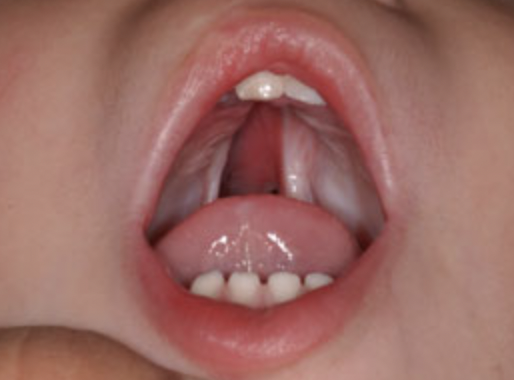 is an opening or split in the roof of the mouth that occurs when the tissue doesn't fuse together during development in the womb