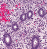 ### Hyperplasia - *Endometrial*