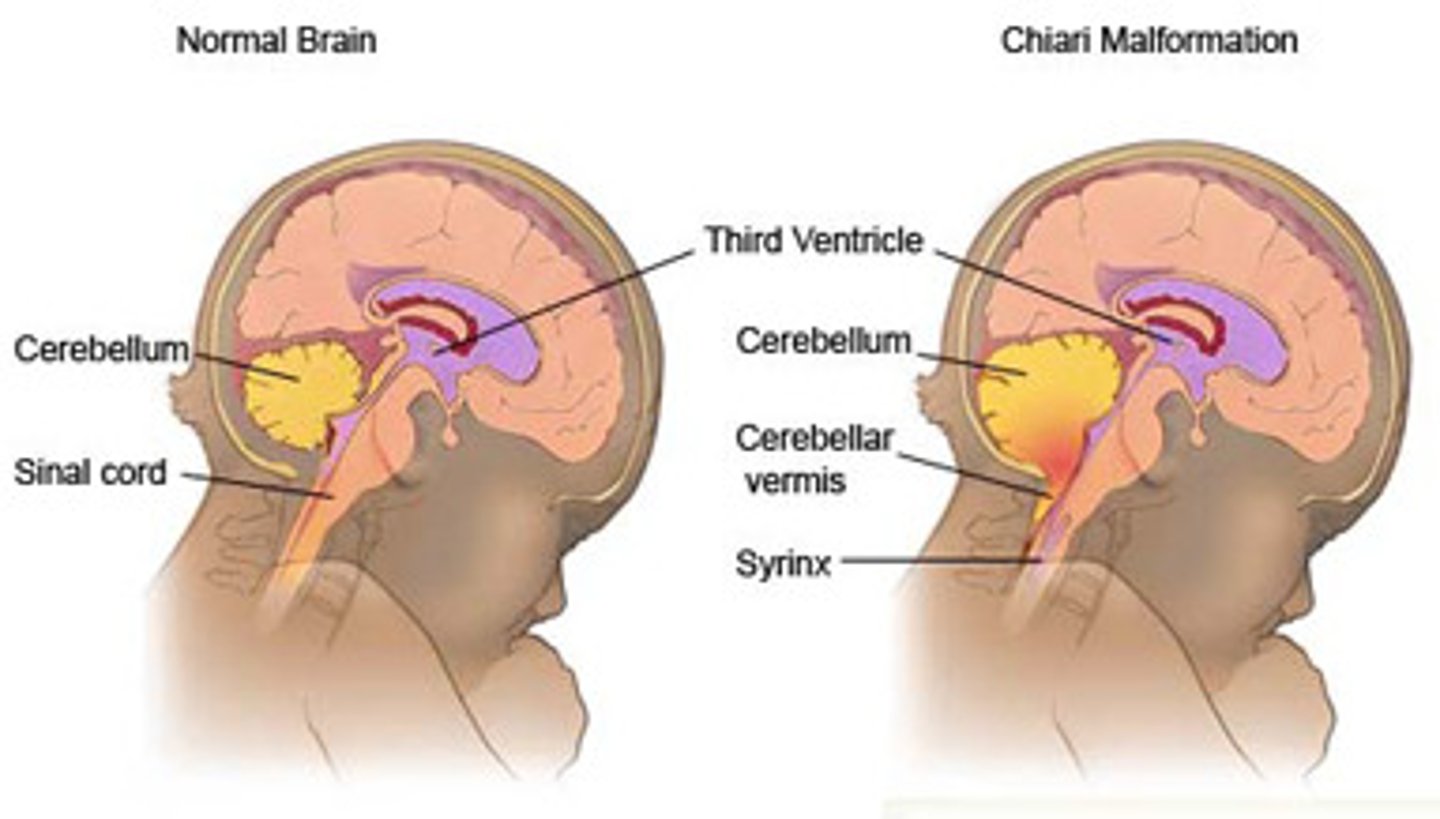 <p>Lemon and banana signs, associated with spina bifida/ myelomeningocele.</p>
