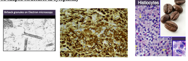<p><span style="background-color: transparent; font-family: "Times New Roman", serif;">*Biopsy: diffuse infiltration of lymphocytes, plasma cells, eosinophils, </span></p><p><span style="background-color: transparent; font-family: "Times New Roman", serif;"> - <strong>large pale staining “histiocytes”/Langerhans Cells indented kidney bean shaped nuclei</strong></span></p><p><span style="background-color: transparent; font-family: "Times New Roman", serif;">*Immunostaining to identify </span></p><p><span style="background-color: transparent; font-family: "Times New Roman", serif;">Langerhans Cells: <strong>S-100+, CD1-a+</strong></span></p><p><span style="background-color: transparent; font-family: "Times New Roman", serif;">*Electron Microscopy: former gold standard </span></p><p><span style="background-color: transparent; font-family: "Times New Roman", serif;"> - <strong>Birbeck Granules (rod shaped structures in cytoplasm)</strong></span></p>