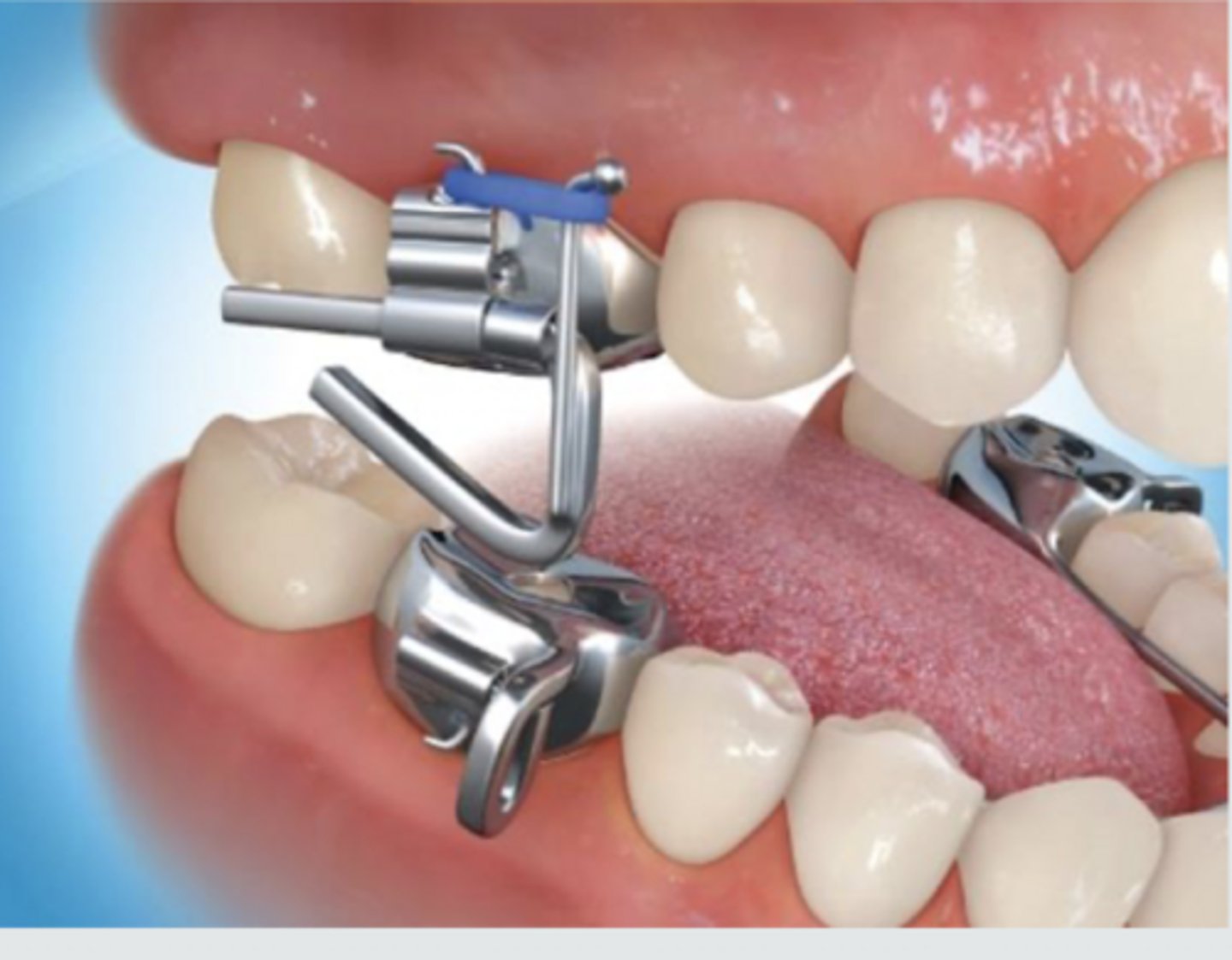 <p>Class II</p><p>Fixed</p><p>Functional</p>