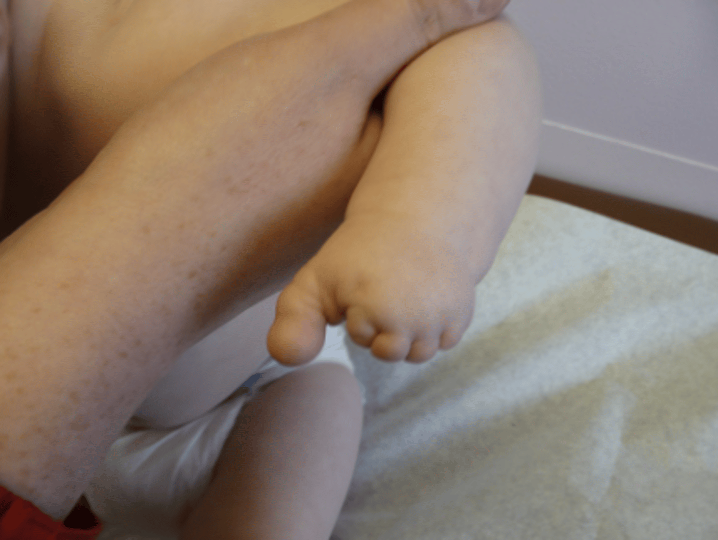 <p>amniotic bands</p>