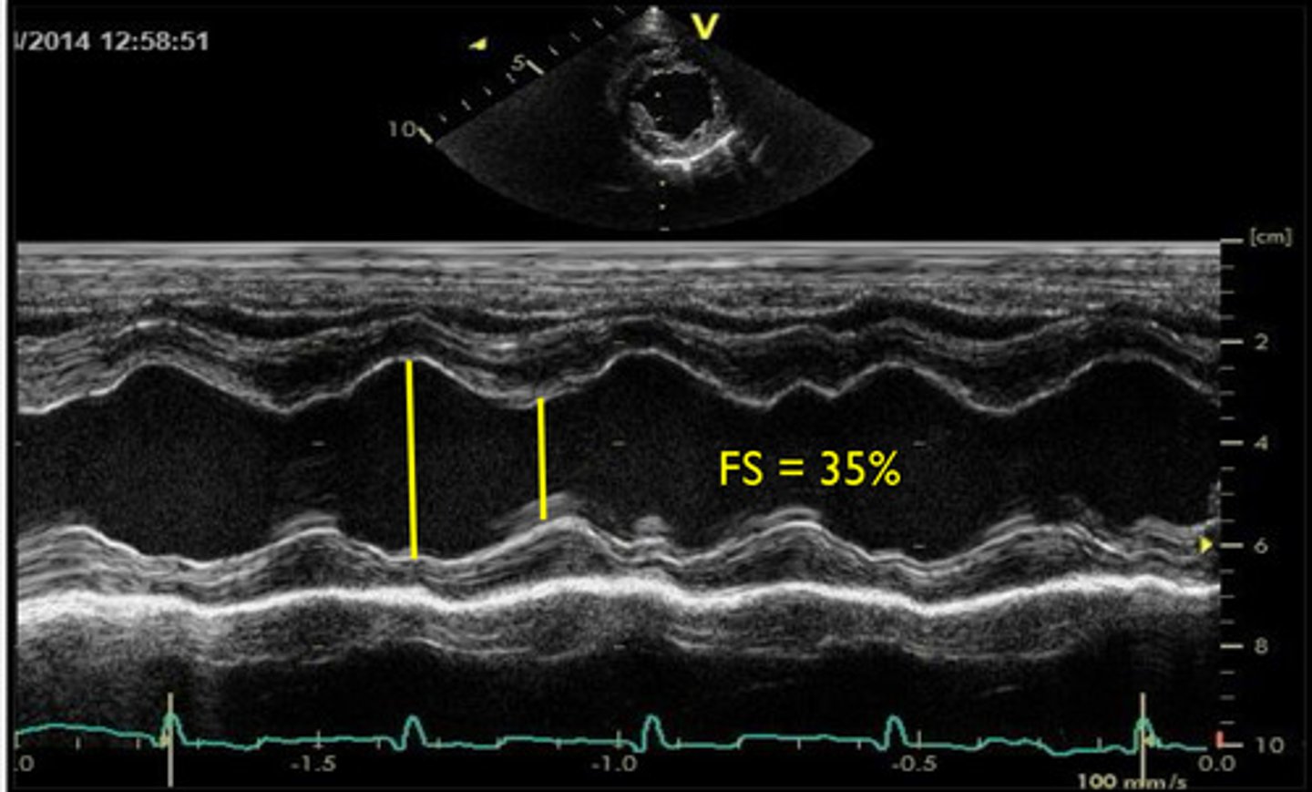 <p>does this show normal or abnormal cardiac function?</p>