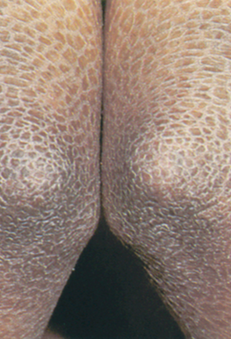 <p>abnormal areas of stratum corneum, may be adherent or loose, large sheet like areas or tiny particles that peel</p><p>caused by inc rate of epidermal cell proliferation</p>