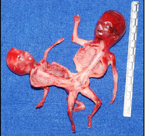 <p>conjoined twins at the abdominal and lower extremity</p>