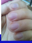 <p>raynaud disease</p>