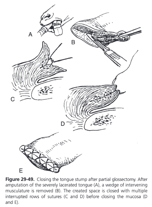 <ul><li><p><span>Reserved for cases in which the rostral tongue tissue is devitalized and minimal attachment is left between the severed section and the remaining body</span></p></li><li><p><span>Tissue color, temperature, and evidence of bleeding at an incision can be used to assess viability</span></p></li><li><p><span>Observation of fluorescence after intravenous administration of sodium fluorescein allows a more objective assessment of tissue vascularization</span></p></li><li><p><span>Mucosal to mucosal closure of the stump is not imperative but is encourages to aid hemostasis, reduce postoperative discomfort associated with an exposed tongue stump, and to hasten wound healing</span></p></li><li><p><span>Correct dorsal-ventral apposition is assisted by removing a wedge of intervening musculature and closing the created space with multiple rows of interrupted absorbable 2-0 or 0 sutures</span></p></li><li><p><span>If necessary, full-thickness tension-relieving mattress sutures may be placed caudal to the mucosa edges to provide additional support to the wound margins</span></p></li><li><p><span>Mucosal edges are closed with exposed or buried 2-0 or 0 absorbable sutures</span></p></li></ul>