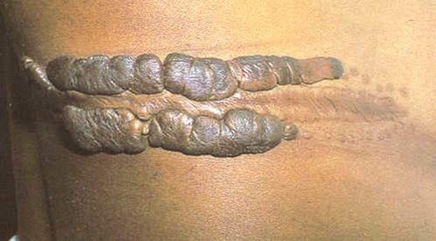 <p>overgrowth outside the confines of cutaneous injury</p><p>location = ears, anterior chest, upper back, and shoulders</p>