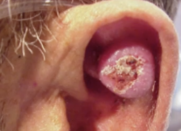 <p>Where would you find cutaneous squamous cell carcinoma?</p>