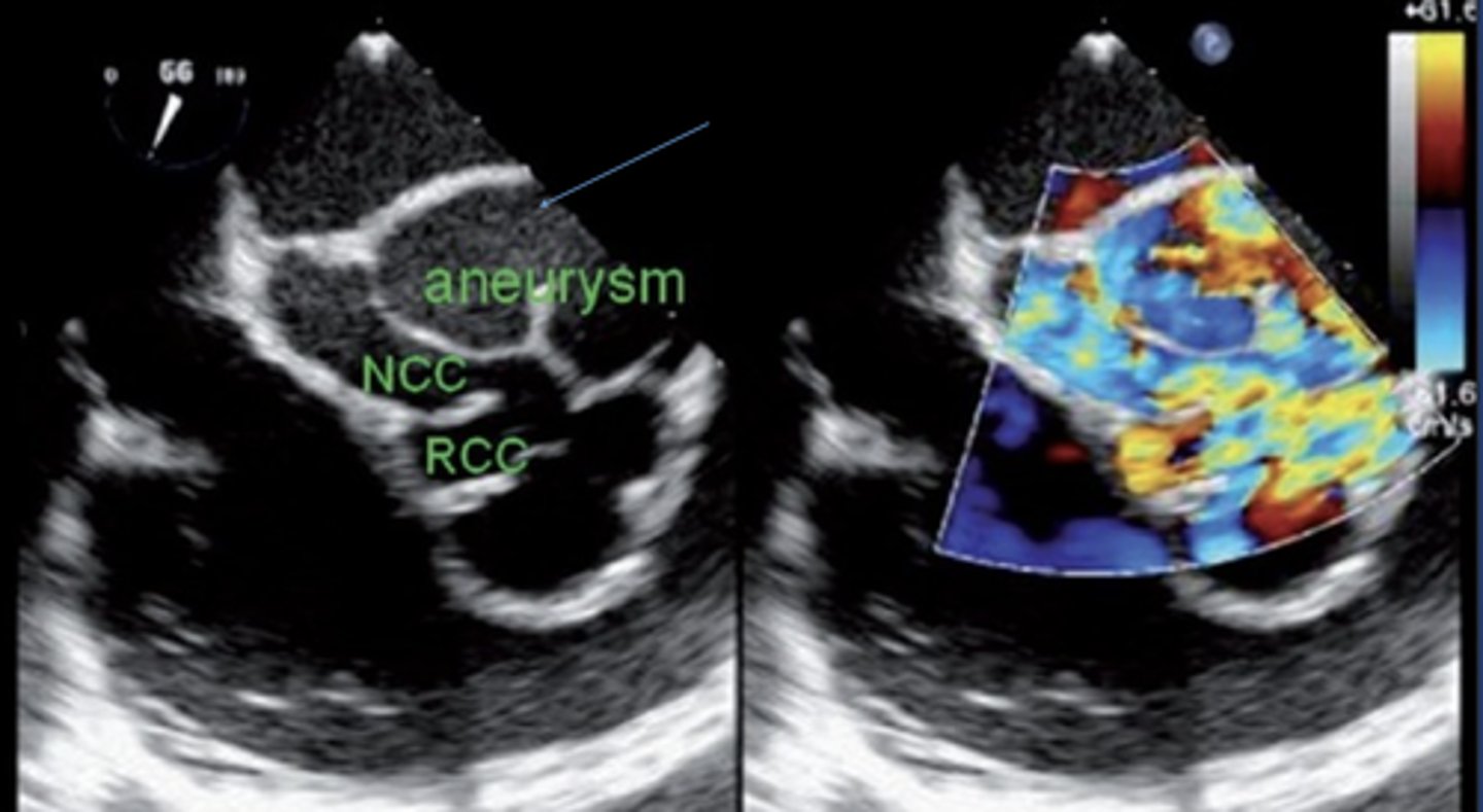 <p>Weakening of wall due to abnormal attachment of prosthetic valve</p>