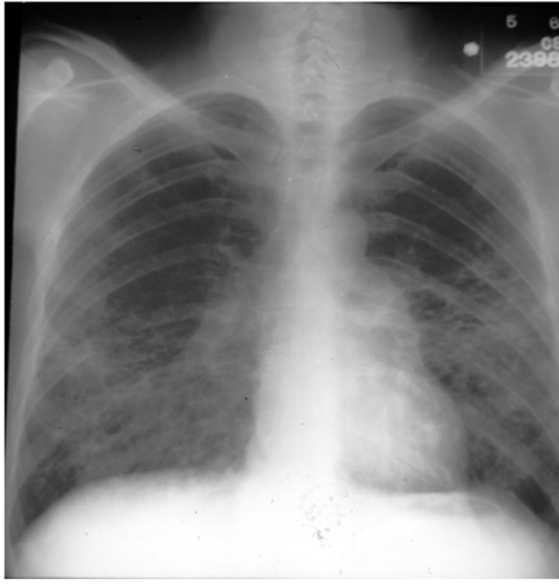<p>asbestos! (exposure occurs in <b>ship-yard workers</b>, demolition workers, milling, etc); severity is directly related to intensity and duration of exposure<br>-<b>minimum of 10 yrs before the disease starts to manifest</b><br><br>-CXR/CT would show <b>honeycombing on BOTTOM PART OF LUNG or pleural plaques</b><br>-asbestosis always <b>starts in lower lung</b> but can end up in upper lung also</p>