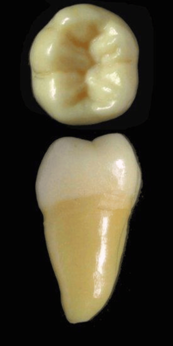 <p>what tooth is this &amp; why?</p>