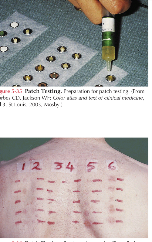 <p>It is used to detect delayed hypersensitivity reactions to a variety of allergens. Potential allergens are applied directly to the skin (Figure 5-35). The sites are evaluated in 72 hours for characteristic erythema and blistering indicating positive reactions</p>