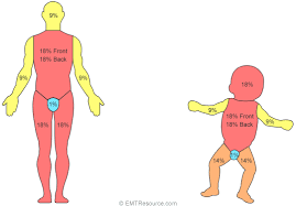 <p>Method of estimating percentage of surface area affected by burns, modified for children (different body proportions).</p>