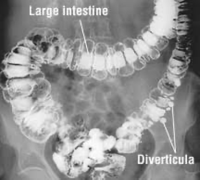<p>Condition of having one or more diverticula</p><p>Not inflamed</p><p>Mostly in sigmoid</p><p>Usually no symptoms</p>