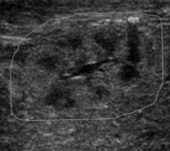 <p>Is the kidney imaged from an adult, child, neonate, or fetus?</p>