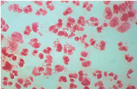 Neisseria meningitidis