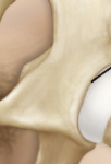 <p>where the three bones in the hip bone meet</p>