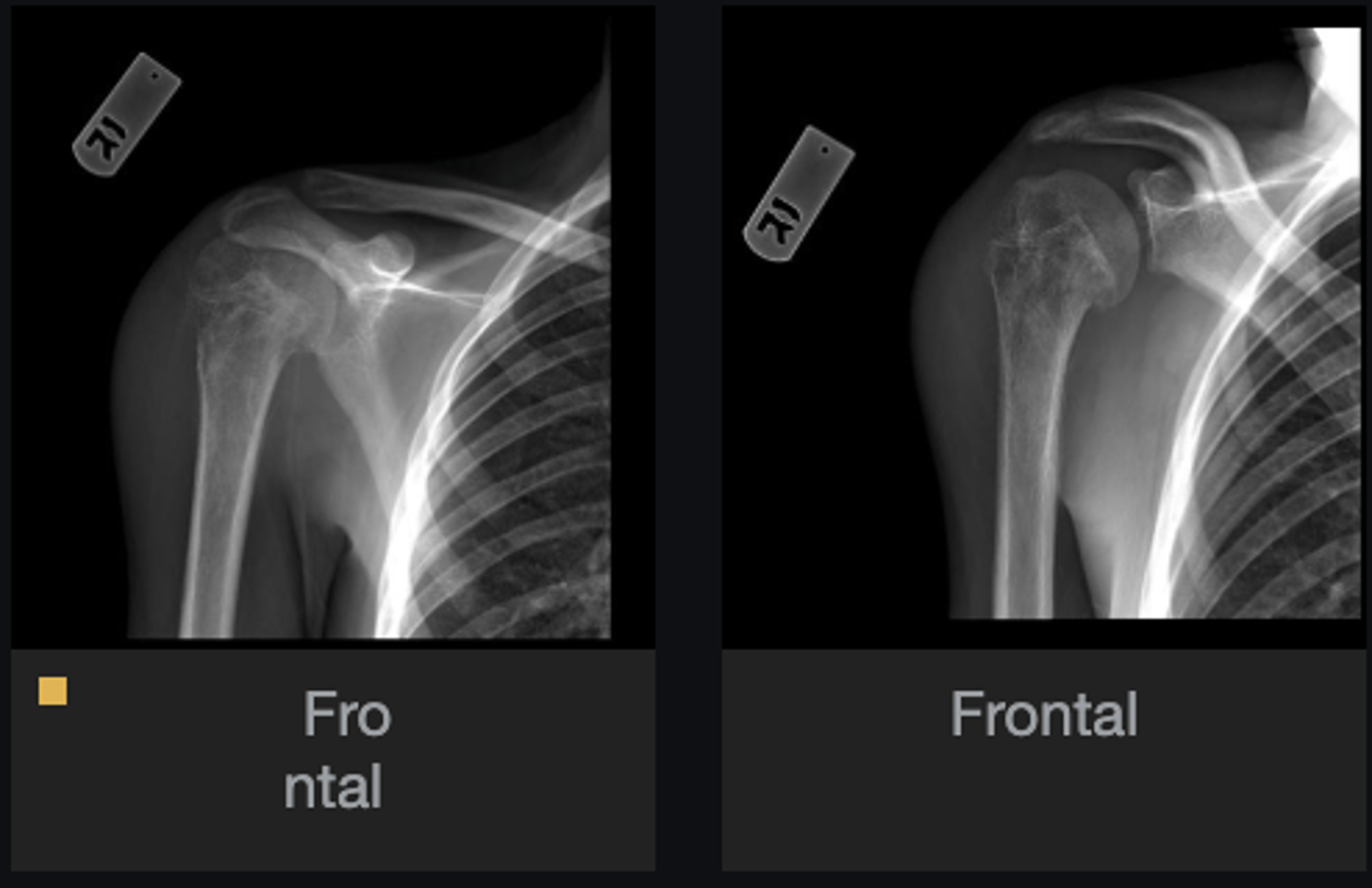 <p>Soft tissue involvement</p>