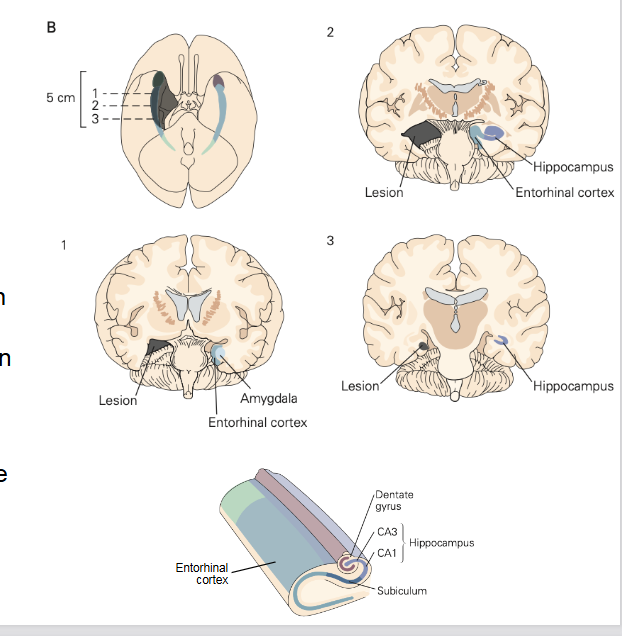 <p>= Henry Molaison</p><ul><li><p>leed aan ernstige epilepsie</p></li><li><p>experimentele operatie: deel van hersenen verwijderd</p><ul><li><p>verwijderen van beide mediale temporale kwabben → incl. hippocampus</p></li></ul></li><li><p>doel: aanvallen stoppen, MAAR: onverwachte gevolgen</p></li></ul><p></p>