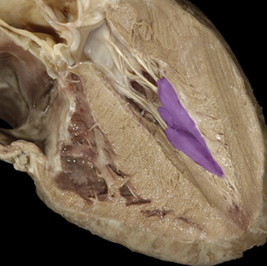 <p>Papillary mm.</p>