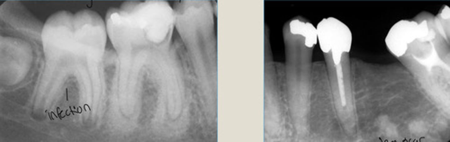 <p>Increased density of both root apices of nonvital 1st M</p><p>Widened PDL</p><p>NO radiolucent rim</p>