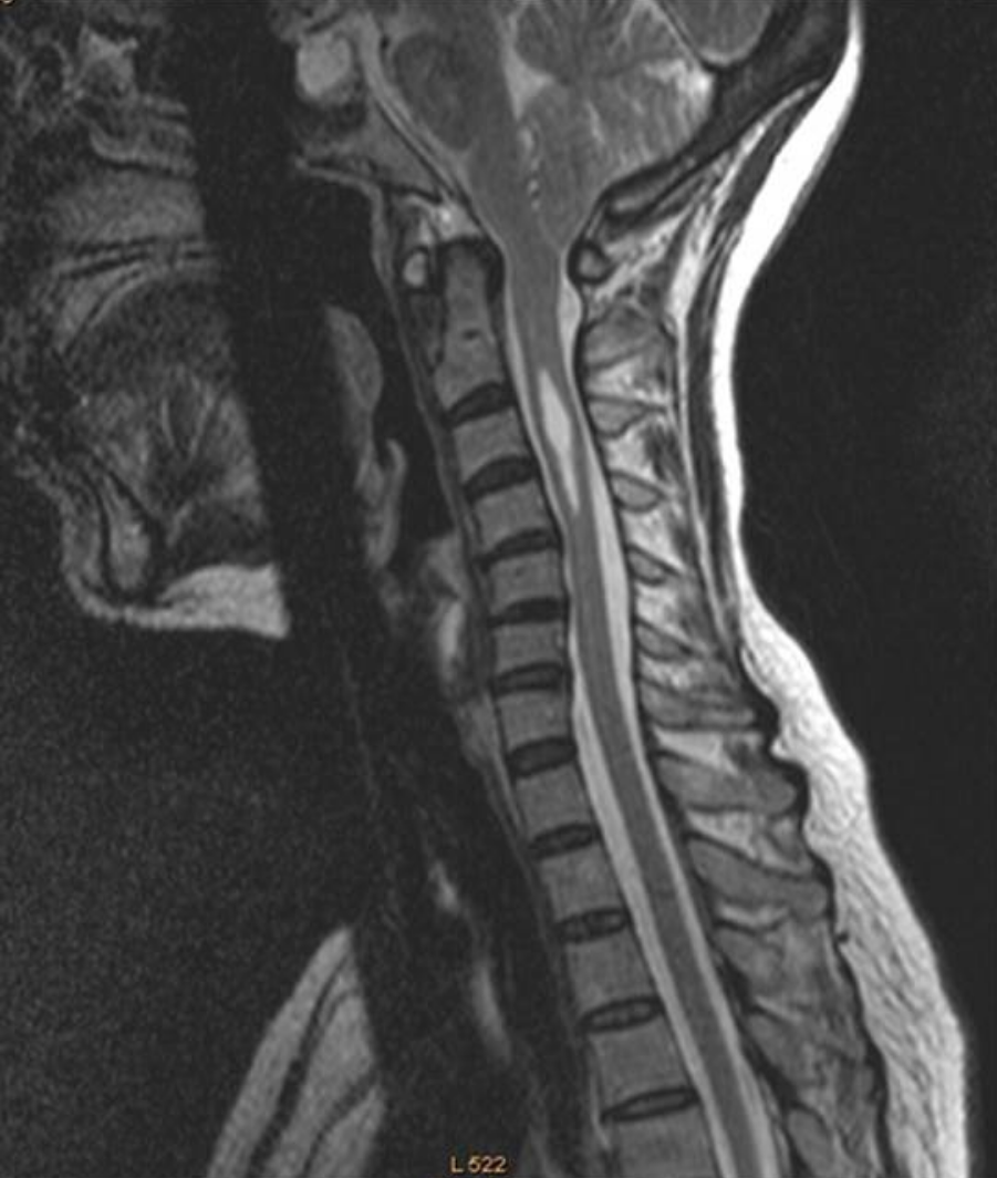 <p>Answers and labeled image below.</p><p>Imaging from a 22-year-old male with weakness reveals the result shown in the accompanying image. What structural abnormalities are observed?</p>