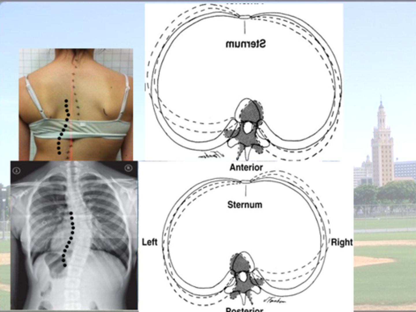 <p>Upper Thoracic = L Lateral Flexion </p><p>ribs on R side </p><p>- elevated </p><p>- IC spaces more open </p><p>ribs on L side </p><p>- depressed </p><p>- IC compressed / shrink </p><p>Rotation to the Right </p><p>Posterior Rib Hump = RIGHT </p><p>(vs. rib flattening on Left) </p><p>VS. </p><p>Lower Thoracic / Upper Lumbar </p><p>= R Lateral Flexion </p><p>LEFT ROTATION</p><p>Posterior Rib Hump on LEFT </p>