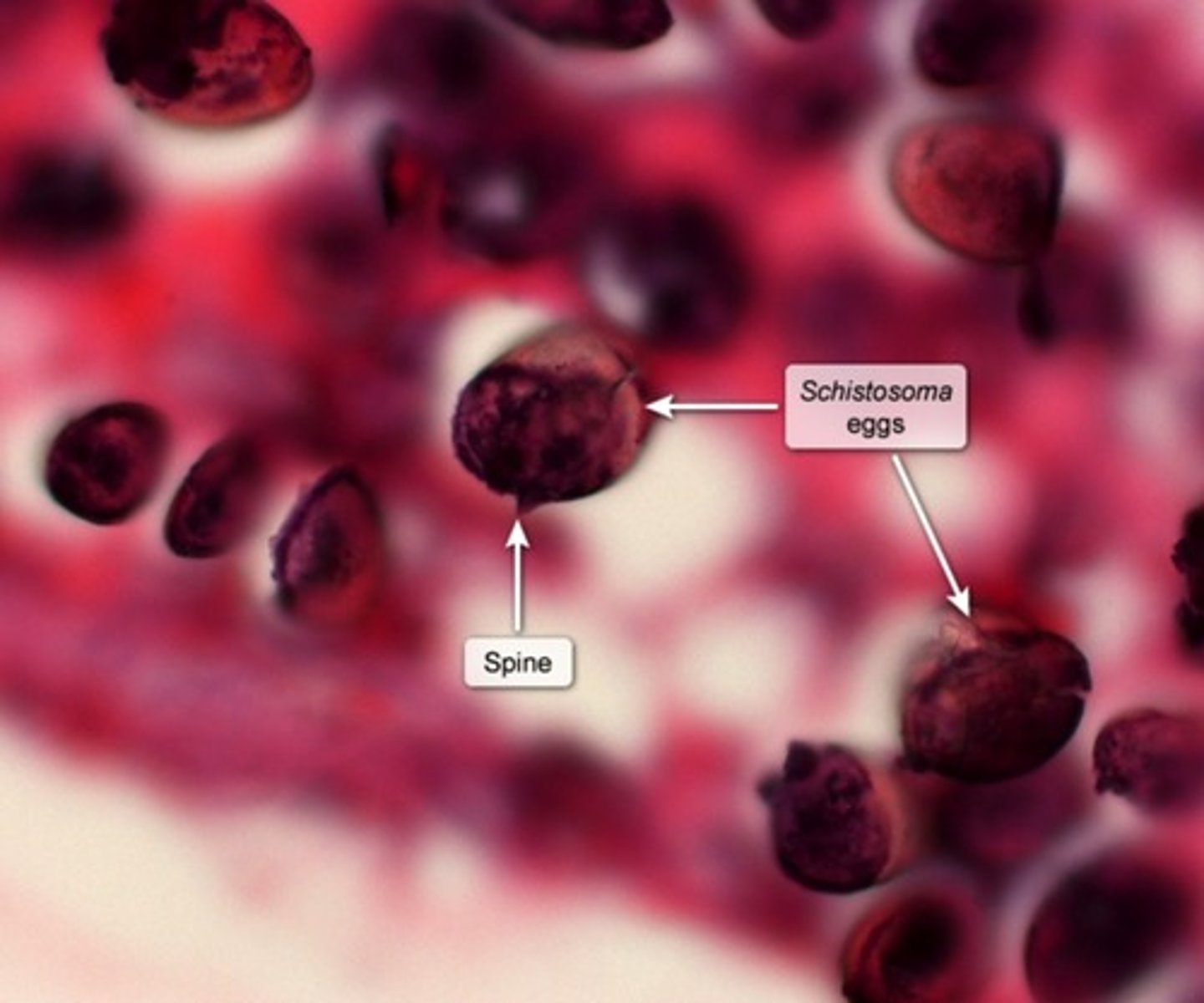 <p>Histo</p><p>-Eosinophilic granulomatous inflammation + Fibrosis</p><p>-Round Oval eggs w/ lateral Spines</p>