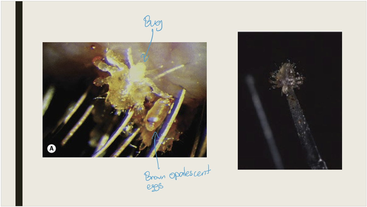 <p>An infestation of the eyelashes by crab lous Phthirus ubis (lice) </p>