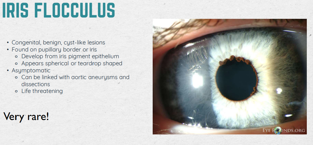 <ul><li><p>Def: congenital, benign, cyst-like lesions</p></li><li><p>Found: on papillary border or iris (develops from iris pigment epithelium, appears spherical or teardrop shapped)</p></li></ul><p></p>