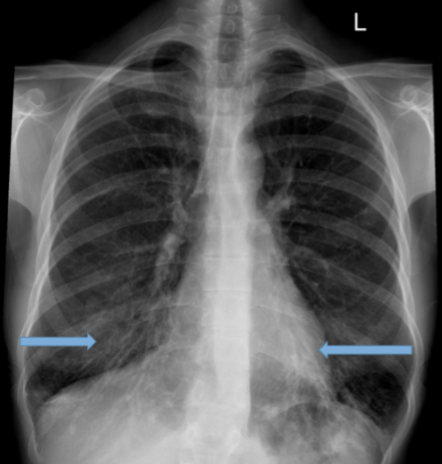 <p>Bronchiectasis CXR</p>